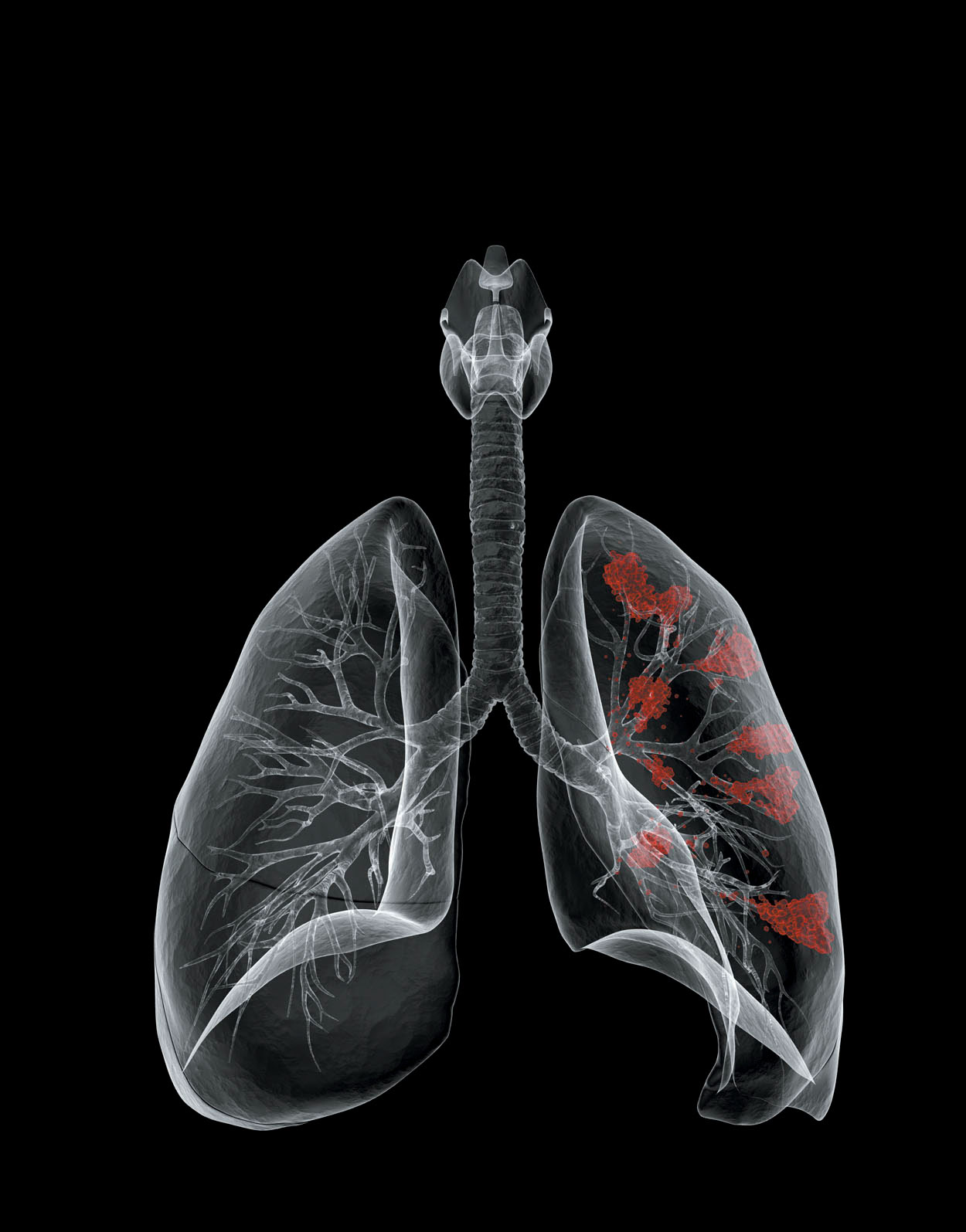 Fungus In Lungs Cancer